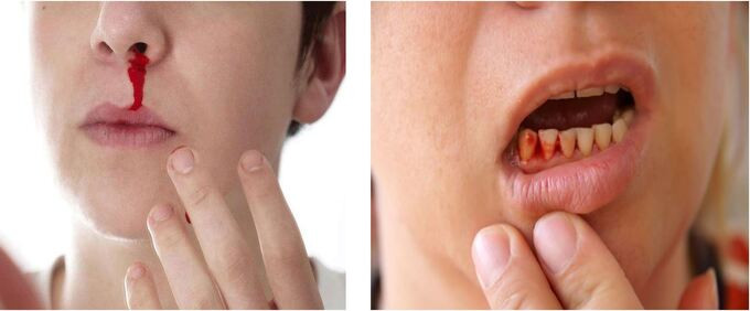 Những dấu hiệu cảnh báo của bệnh sốt xuất huyết Dengue