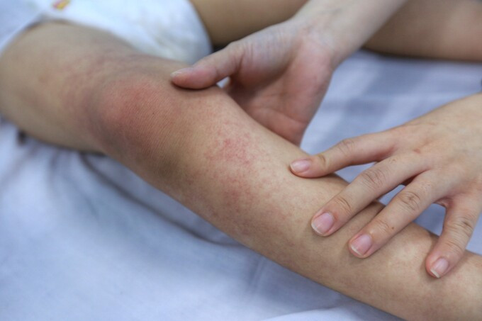 TP. HCM: Số ca mắc mới sốt xuất huyết đã và đang có dấu hiệu giảm dần