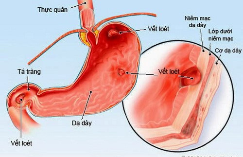 Những điều cần biết về viêm dạ dày trẻ em