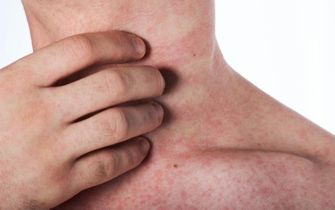 Sốt xuất huyết có 3 giai đoạn cần lưu ý