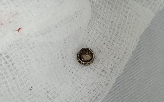 Long An điều trị thành công cho bé gái mắc phải dị vật pin đồ chơi trong mũi