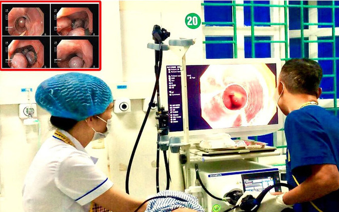 Hà Giang cấp cứu bệnh nhân xuất huyết tiêu hóa nặng do vỡ tĩnh mạch thực quản