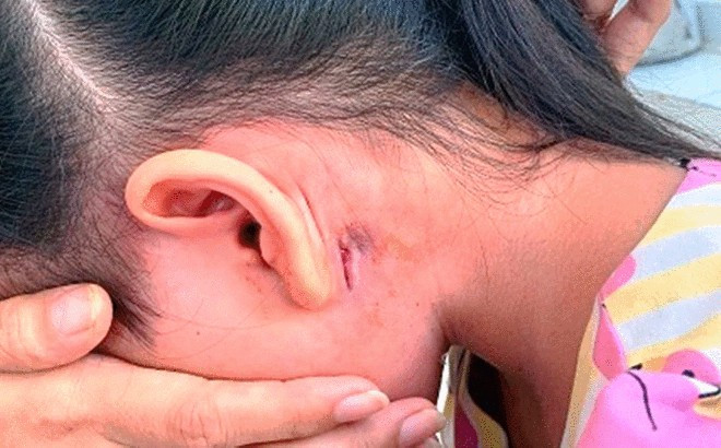 Triệu chứng của bệnh Whitmore