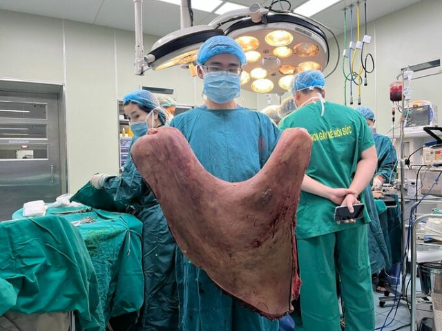 Hà Nội phẫu thuật thành công cho một bệnh nhân có khối u sợi thần kinh kích thước khổng lồ