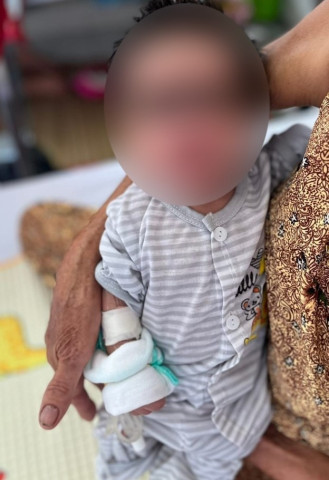 Cần Thơ cứu sống bé trai 16 ngày tuổi mắc uốn ván sơ sinh nguy kịch