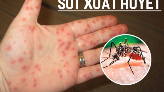 Điều trị bệnh sốt xuất huyết theo y học cổ truyền
