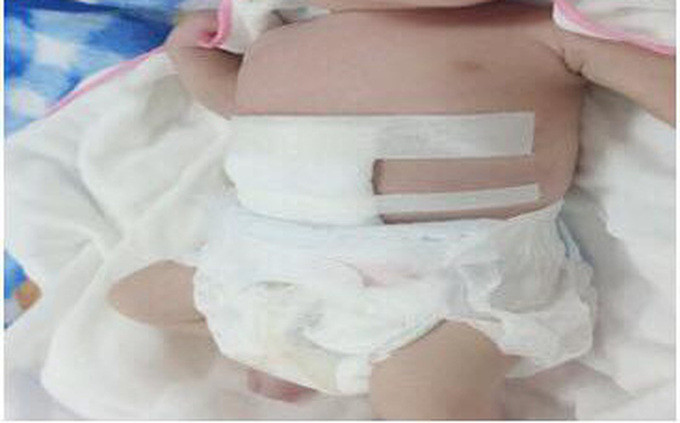 Sơn La cứu sống bé sơ sinh chào đời có ruột nằm ngoài ổ bụng
