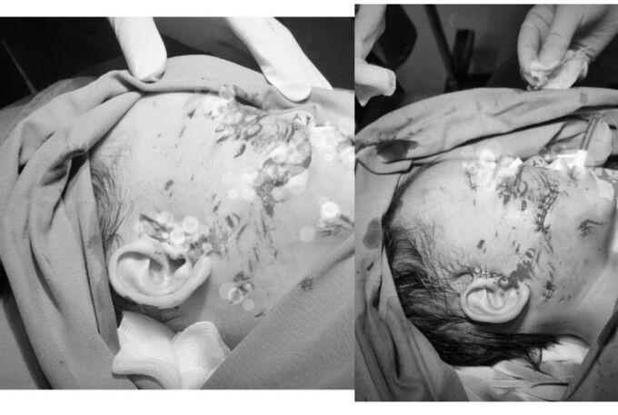 Cao Bằng: Bé 28 tháng tuổi bị chó cắn gây tổn thương nghiêm trọng vùng mặt