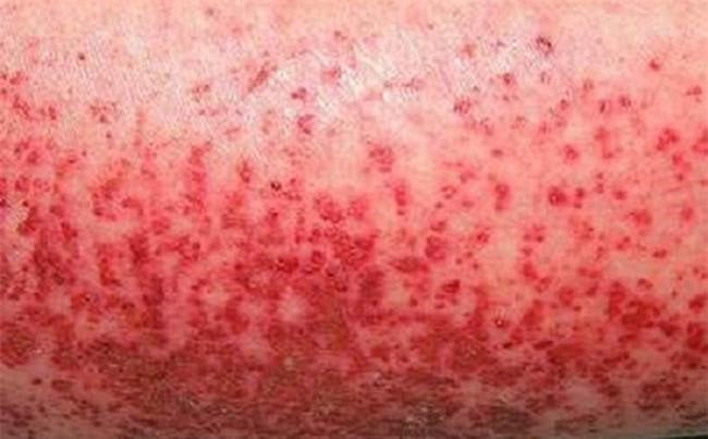 TP. HCM: Cô gái 19 tuổi béo phì bị biến chứng nguy hiểm khi mắc sốt xuất huyết