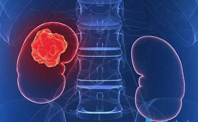 Suy thận mạn tính có những biến chứng theo từng giai đoạn