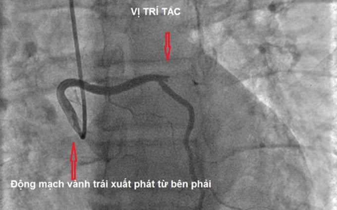 Hà Nội cấp cứu bệnh nhân nhồi máu cơ tim cấp có bất thường giải phẫu động mạch vành