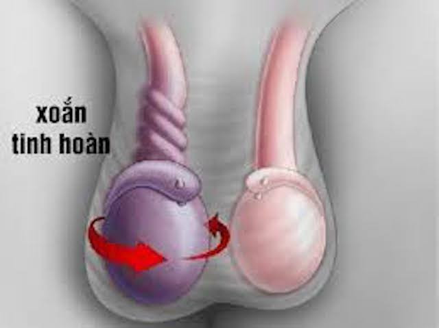 Trời lạnh có thể làm tăng tỉ lệ xoắn tinh hoàn
