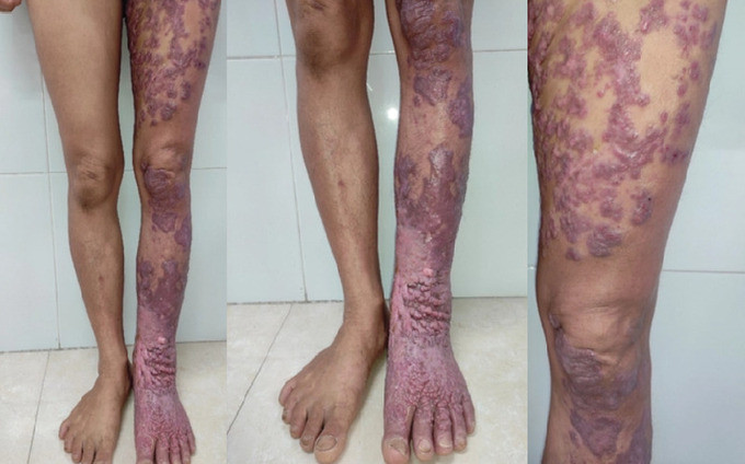 Hà Nội tiếp nhận một trường hợp nhiễm nấm Chromoblastomycosis