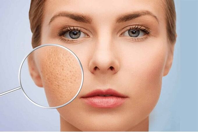 Những lỗi chăm sóc da khiến lỗ chân lông ngày càng to