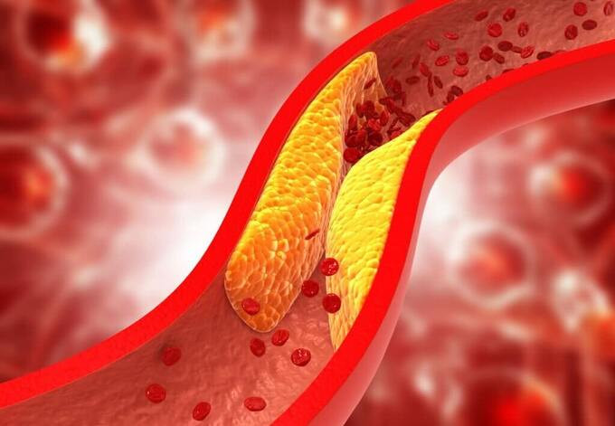 Người bị máu nhiễm mỡ nên ăn gì, kiêng gì vào dịp tết?