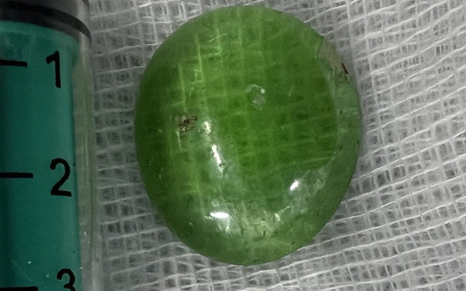 TP. HCM lấy thành công viên sỏi tròn 3cm trong thực quản bé trai 18 tháng tuổi