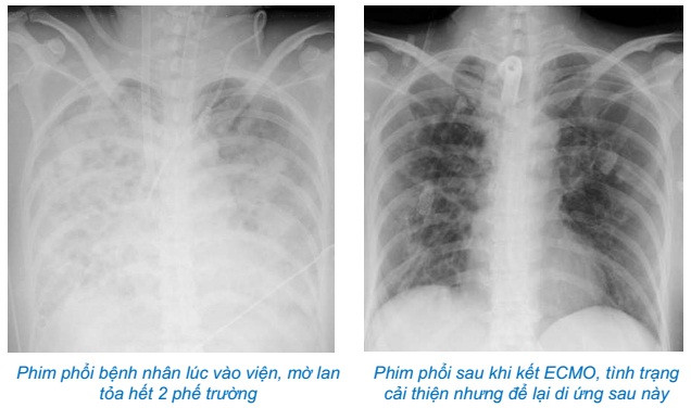 Hà Nội điều trị thành công cho bệnh nhân bị viêm phổi bội nhiễm, suy đa tạng do lạm dụng corticoid tự điều trị cúm