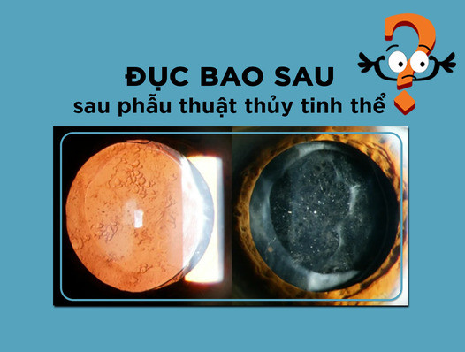 Đục bao sau sau phẫu thuật thủy tinh thể