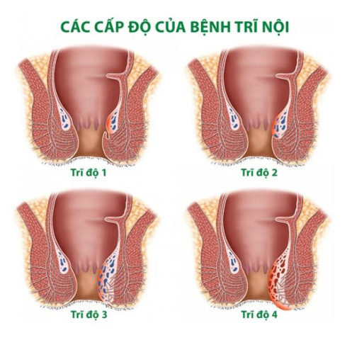 Bệnh trĩ gây ảnh hưởng từ 30 - 35% dân số nước ta