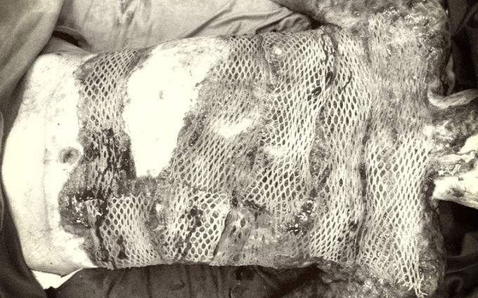 Cảnh báo điều trị bỏng tại nhà hoặc bằng Đông y gây hậu quả nghiêm trọng