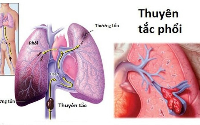 Các yếu tố nguy cơ, chẩn đoán, điều trị thuyên tắc phổi