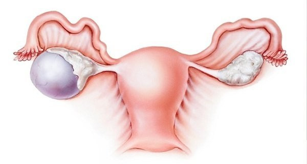 Điều trị u nang buồng trứng bằng phương pháp dân gian