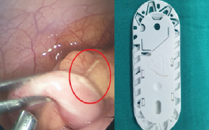 Hải Phòng: Bệnh nhi 8 tuổi hóc xương cá thủng ruột thừa