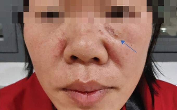 Hy hữu trường hợp tái phát ung thư da do phẫu thuật tại cơ sở y tế không chuyên khoa