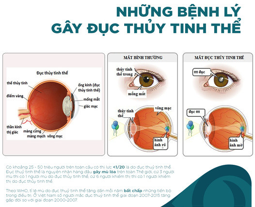 Những bệnh lý có thể gây đục thủy tinh thể