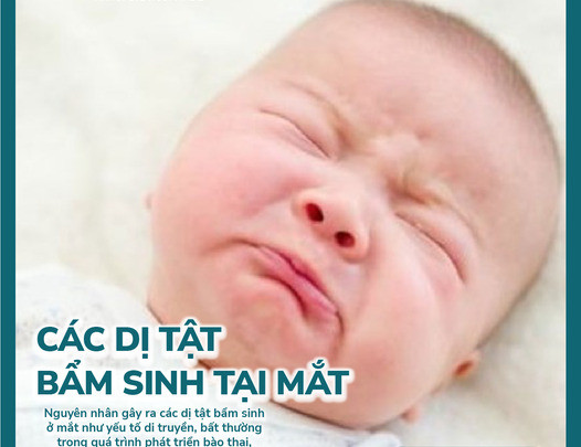 Các dị tật bẩm sinh tại mắt