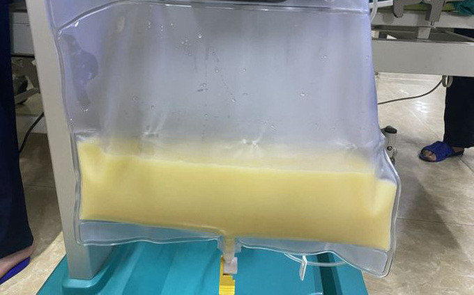 Phú Thọ thay huyết tương cấp cứu nam bệnh nhân viêm tuỵ cấp, máu trắng đục như sữa