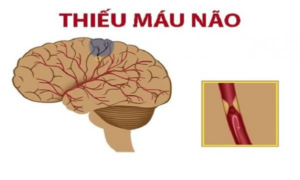 Các cây thuốc nam chữa bệnh thiếu máu não