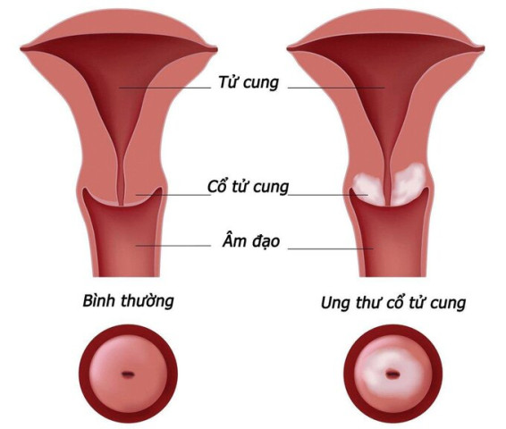 Những điều cần biết về vaccine HPV