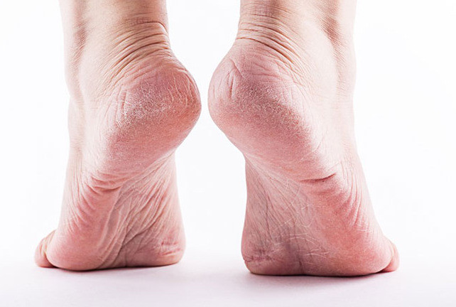 Cách bảo vệ gót chân không bị khô, nứt nẻ vào mùa đông