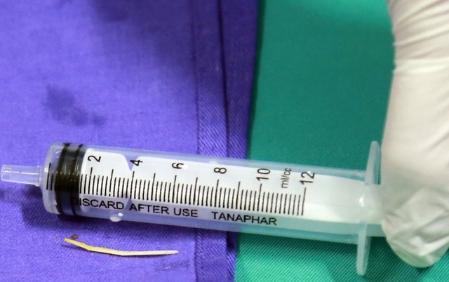 Quảng Ninh gắp tăm tre 3cm trong tá tràng của nữ bệnh nhân