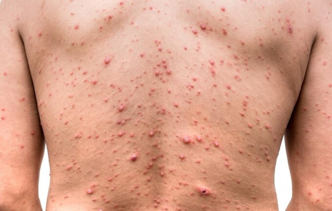 Những điều cần biết về bệnh thủy đậu