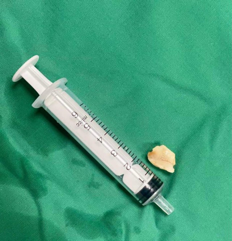 Quảng Bình gắp thành công dị vật là một nửa hạt lạc nằm nhiều ngày trong phế quản của một bệnh nhân