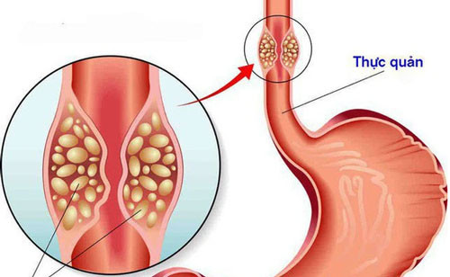 Quảng Ninh: Một bệnh nhân đi khám viêm họng phát hiện bị ung thư thực quản