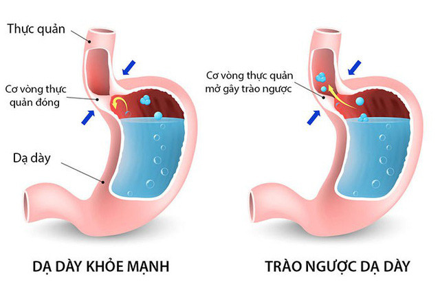 Mối quan hệ giữa trào ngược dạ dày thực quản và viêm loét dạ dày