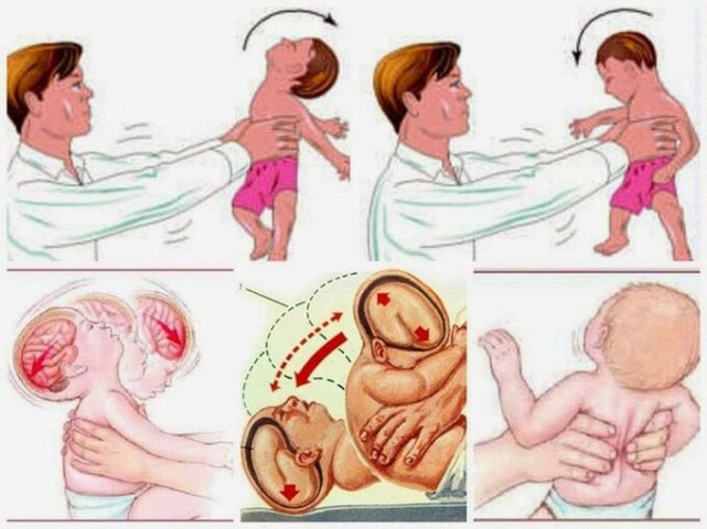 Khánh Hòa: Bệnh nhi 4 tháng tuổi bị chảy máu não do hội chứng rung lắc khi bế trẻ