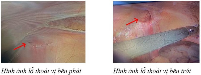 Thoát vị bẹn phát hiện và điều trị muộn có thể gây các biến chứng đe dọa đến tính mạng