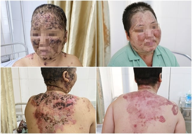 Quảng Ninh: Sử dụng lá cây tắm chữa Pemphigus, bệnh nhân bị viêm da trầm trọng