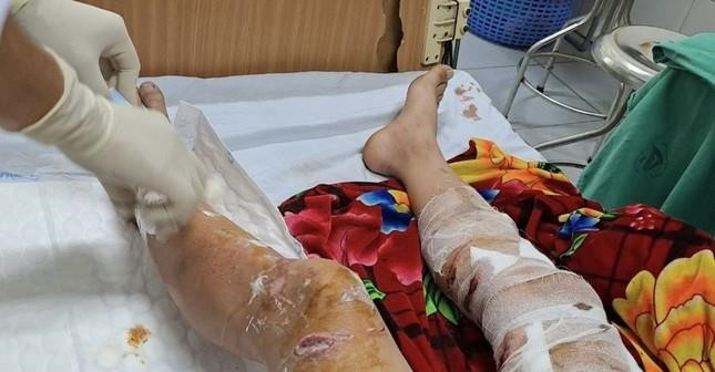 Lào Cai: Một nam sinh bị chó thả rông cắn gây thương tích nặng