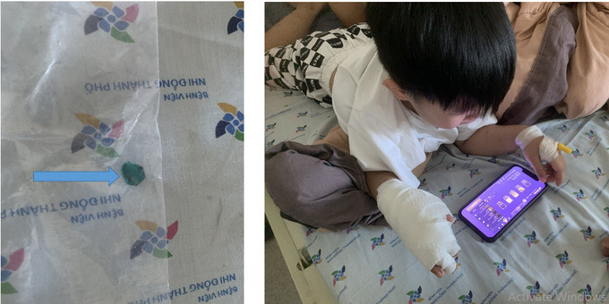 TP. HCM: Bé trai 5 tuổi nghịch pháo bị phỏng nặng bàn tay phải