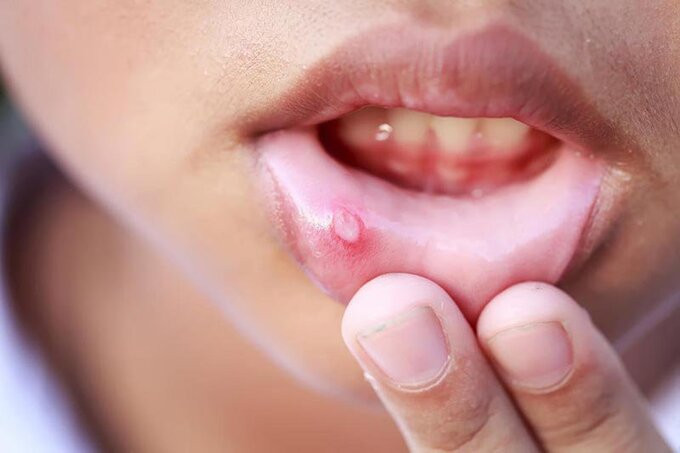 Một số cây thuốc dân gian có tác dụng chữa nhiệt miệng