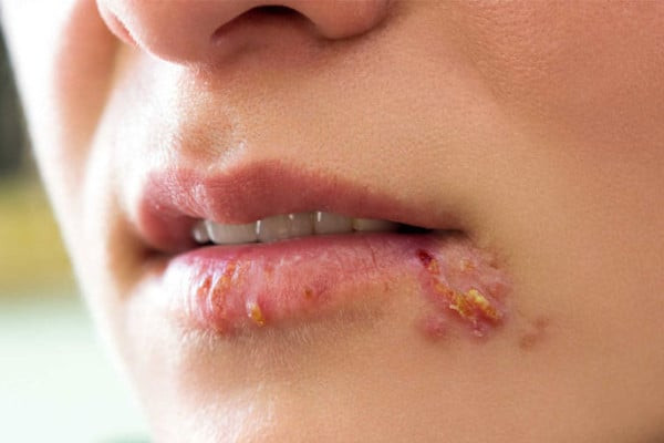 Một số phương pháp điều trị chốc mép hiệu quả