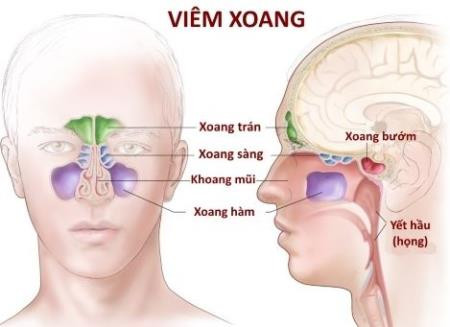 Mối liên quan giữa bệnh viêm xoang và viêm họng mạn tính