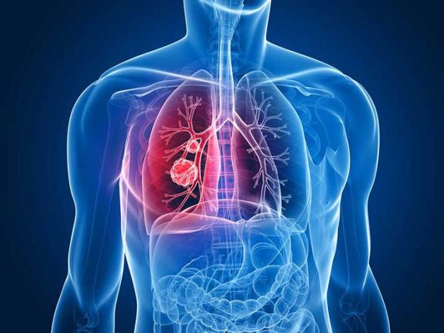 Tầm soát ưng thư phổi là một vấn đề hết sức quan trọng