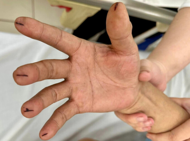 TP. HCM: Một bệnh nhân bị đột quỵ được "chữa" bằng cách rạch dao lam 5 đầu ngón tay theo "thầy thuốc online" gây mất máu nhiều