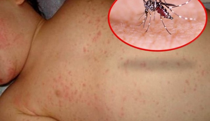 Phú Yên ghi nhận 2 trẻ tử vong do sốt xuất huyết